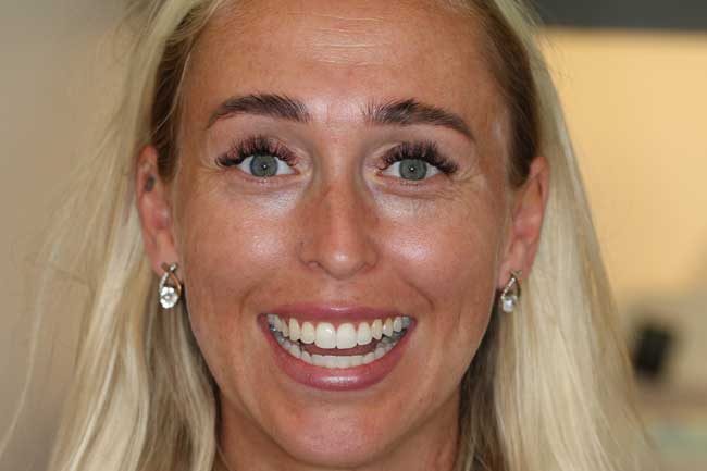 tænder efter behandling med Invisalign