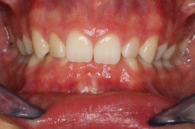 tænder før behandling med Invisalign