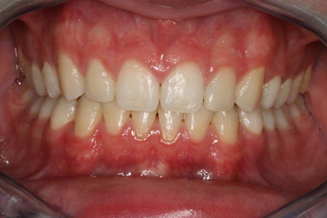 tænder efter behandling med Invisalign