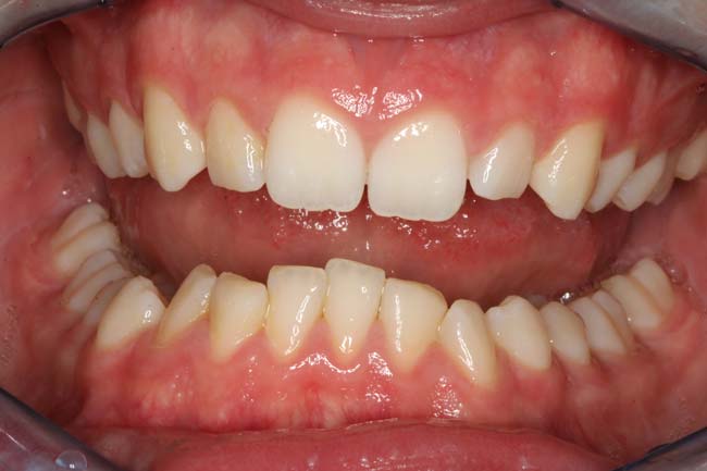tænder før behandling med Invisalign