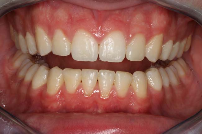 tænder efter behandling med Invisalign