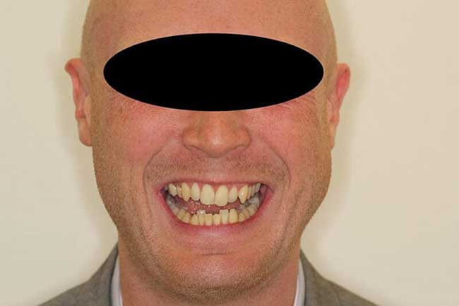 tænder efter behandling med Invisalign