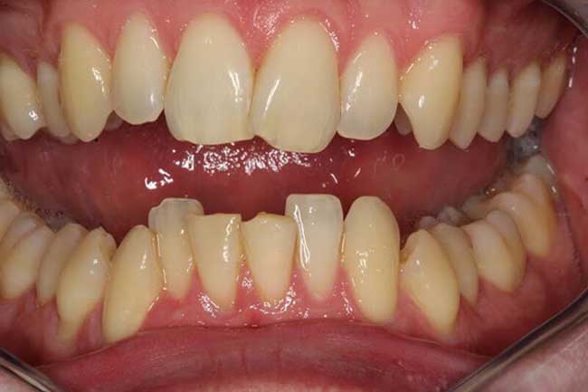 tænder efter behandling med Invisalign