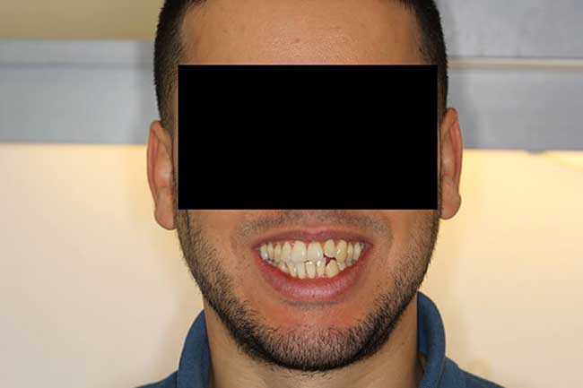 tænder efter behandling med Invisalign