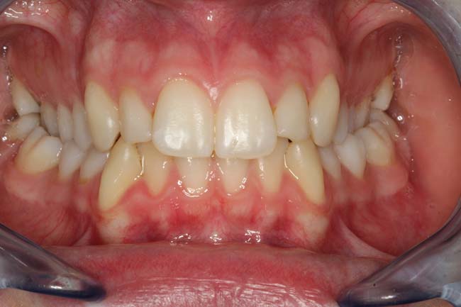 tænder før behandling med Invisalign