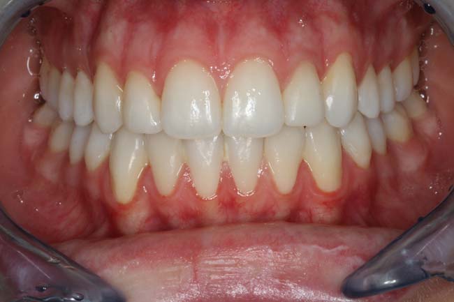 tænder efter behandling med Invisalign