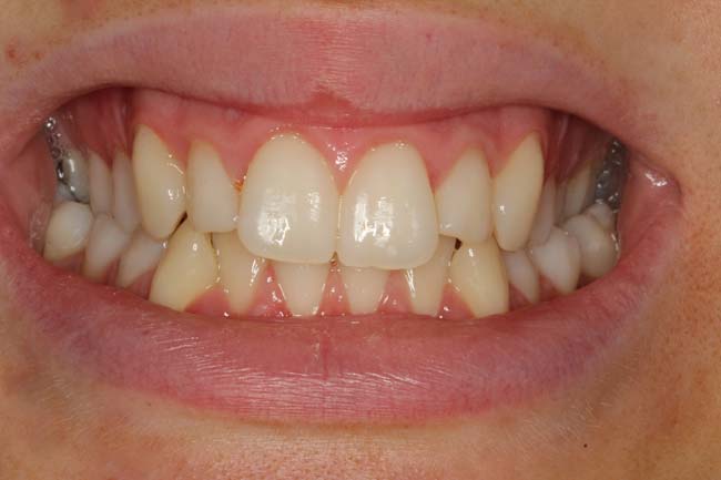 tænder før behandling med Invisalign