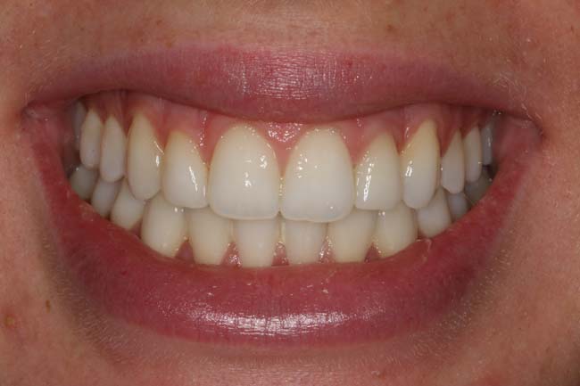 tænder efter behandling med Invisalign