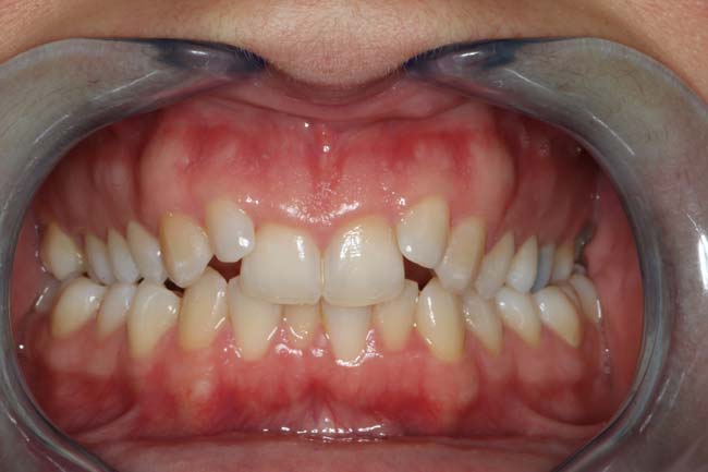 tænder før behandling med Invisalign