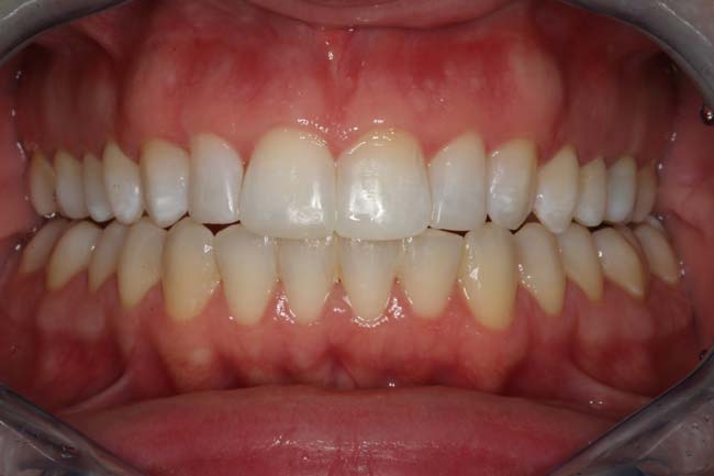 tænder efter behandling med Invisalign