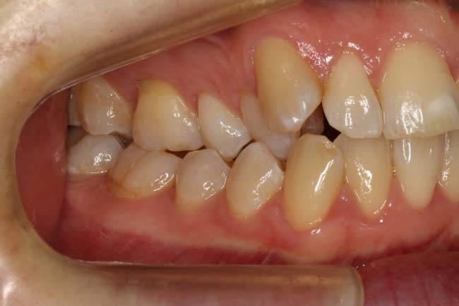 tænder før behandling med Invisalign