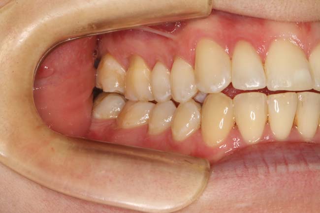 tænder efter behandling med Invisalign