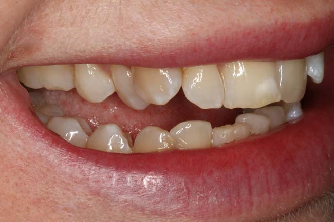 tænder før behandling med Invisalign