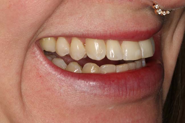 tænder efter behandling med Invisalign