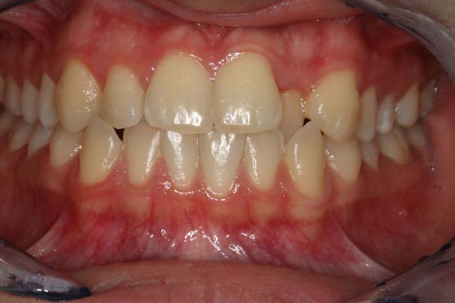 tænder før behandling med Invisalign