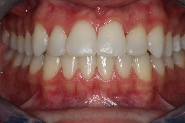 tænder efter behandling med Invisalign