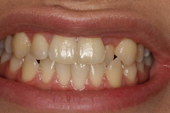 tænder før behandling med Invisalign