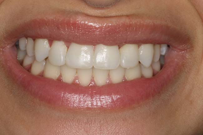 tænder efter behandling med Invisalign
