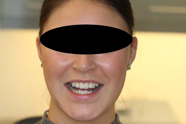 tænder før behandling med Invisalign