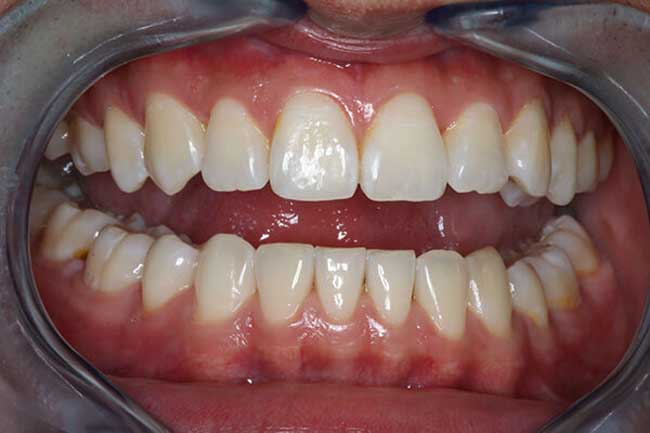 tænder efter behandling med Invisalign