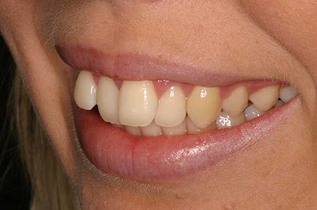 tænder før behandling med Invisalign