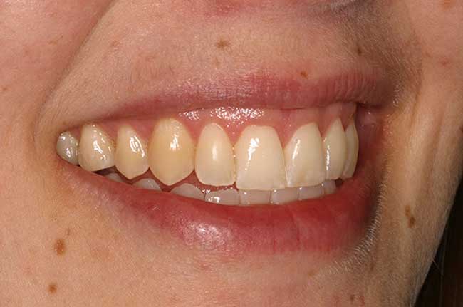 tænder efter behandling med Invisalign