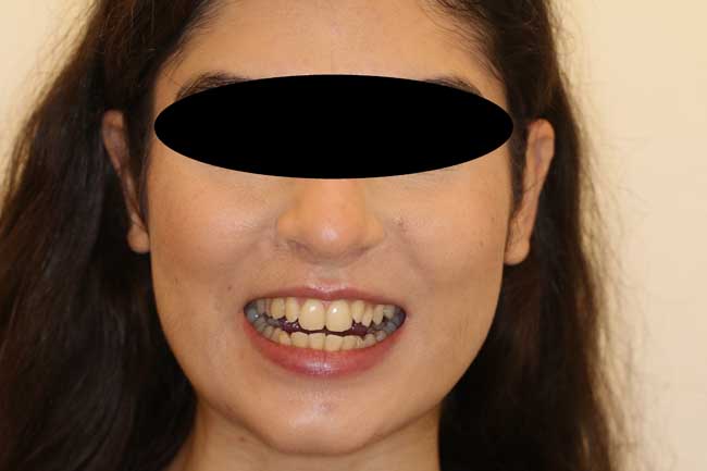 tænder før behandling med Invisalign