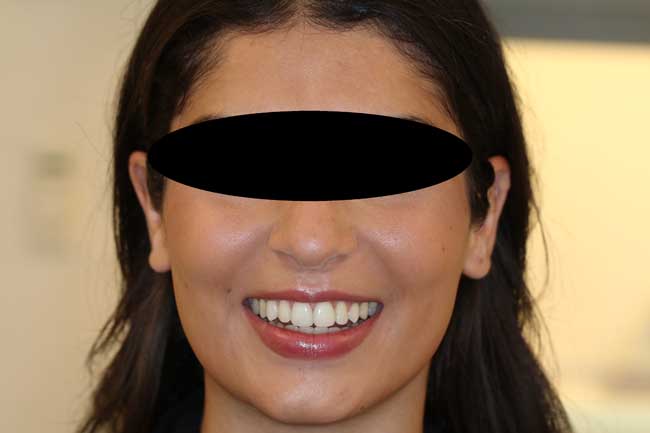 tænder efter behandling med Invisalign