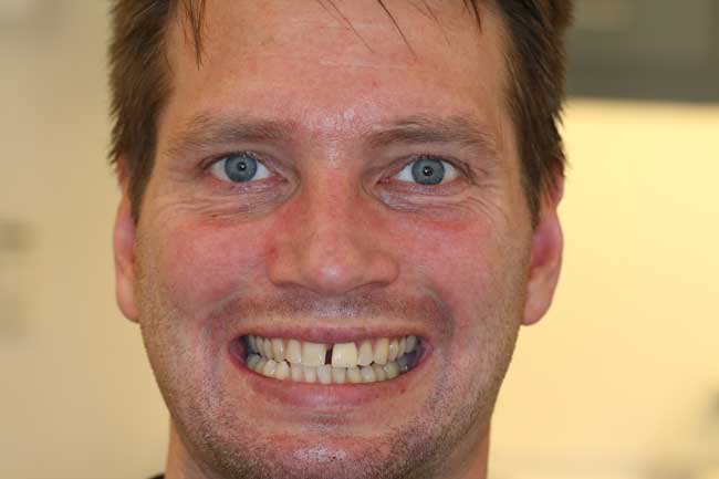 tænder efter behandling med Invisalign