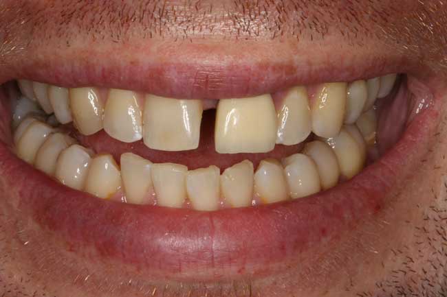 tænder efter behandling med Invisalign