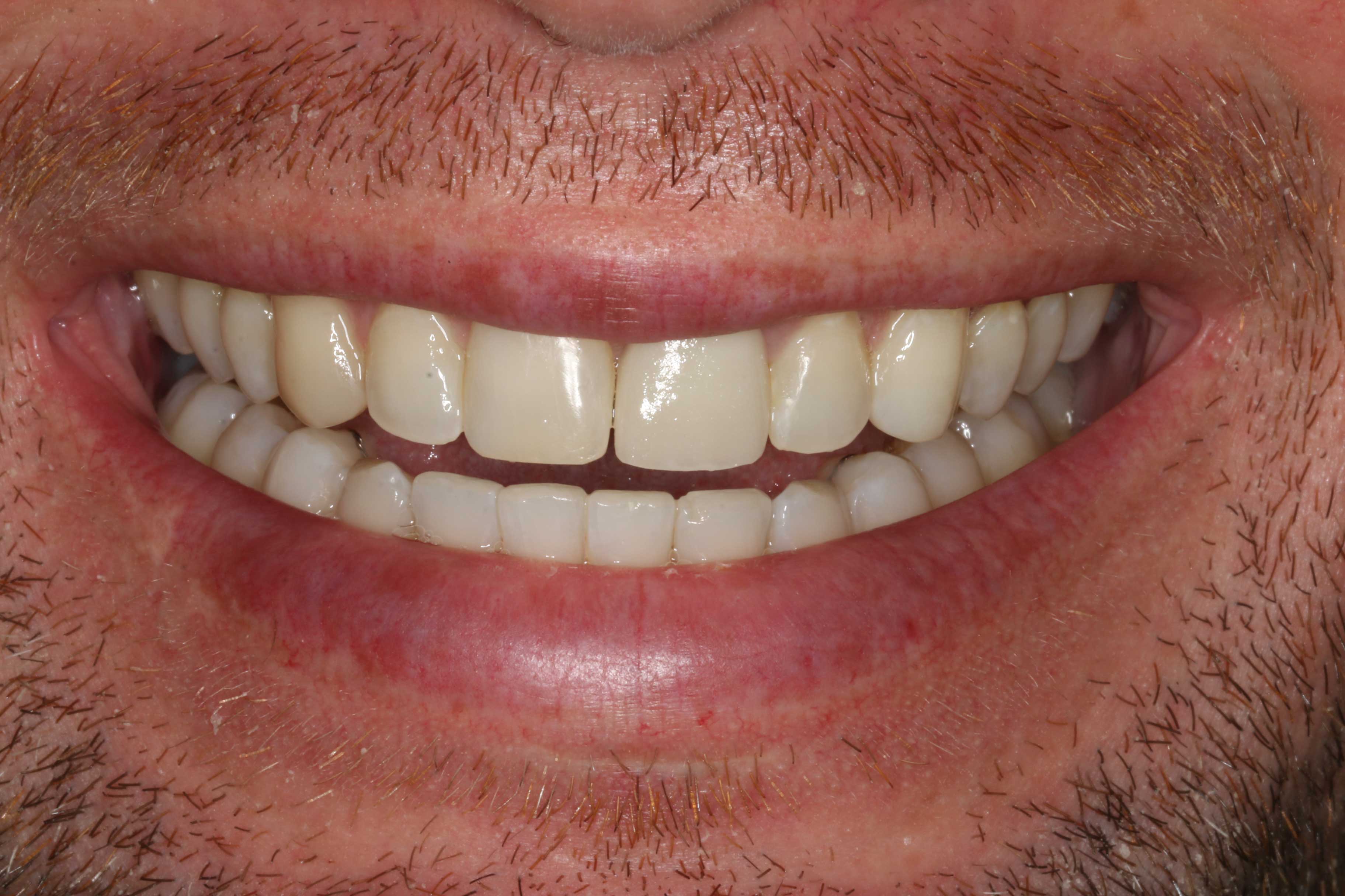 tænder efter behandling med Invisalign