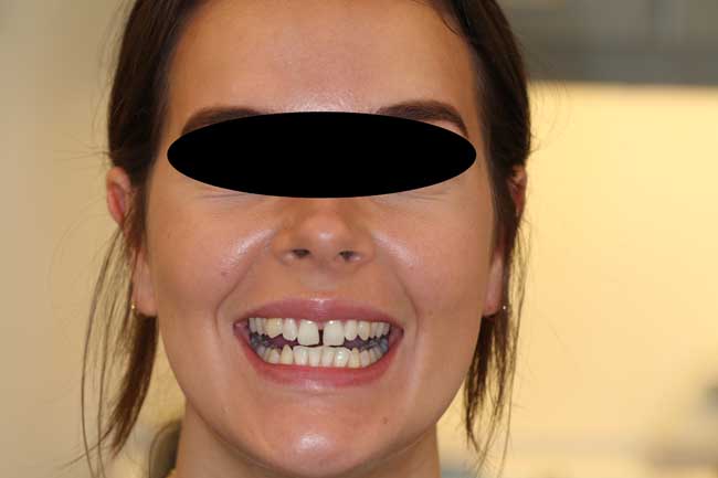 tænder før behandling med Invisalign