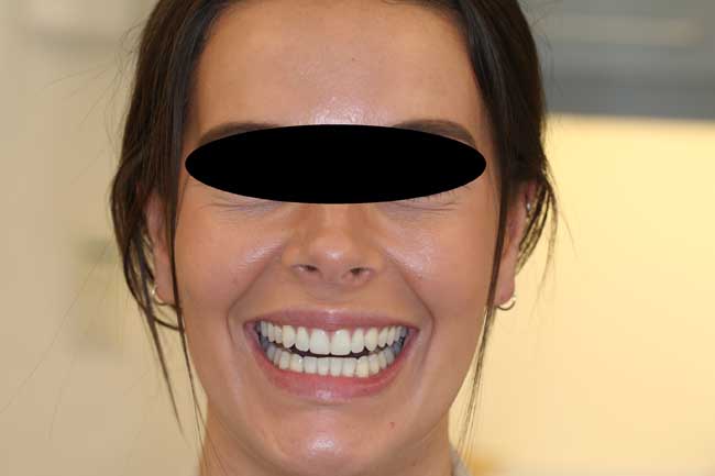 tænder efter behandling med Invisalign