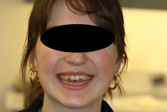 tænder før behandling med Invisalign