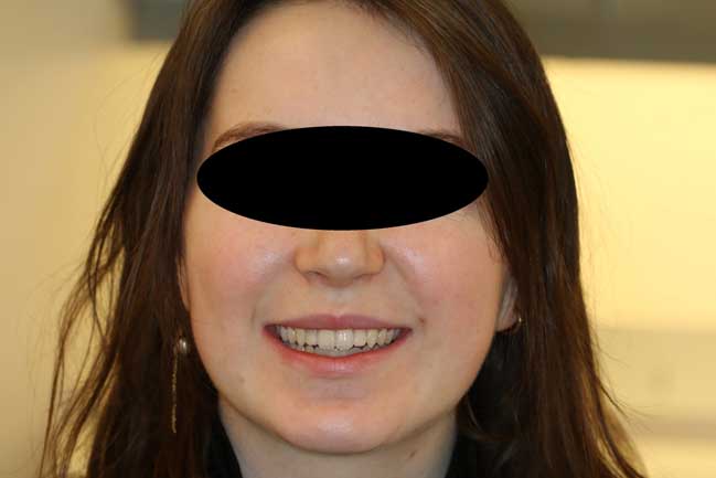 tænder efter behandling med Invisalign