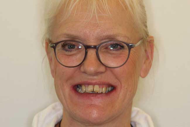 tænder før behandling med Invisalign