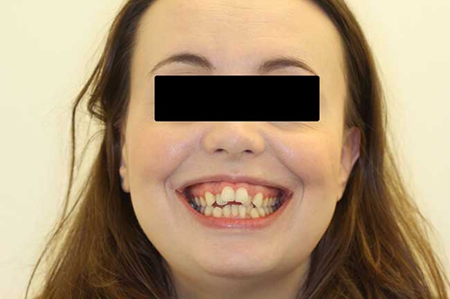 tænder før behandling med Invisalign