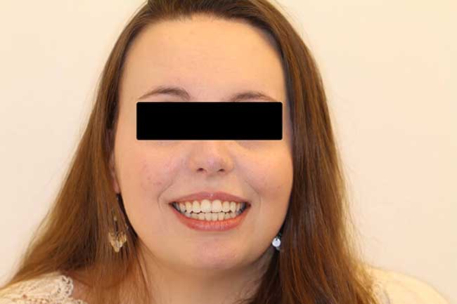 tænder efter behandling med Invisalign