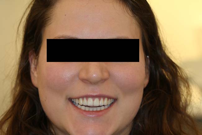 tænder efter behandling med Invisalign