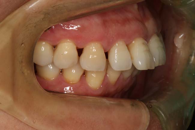 tænder før behandling med Invisalign