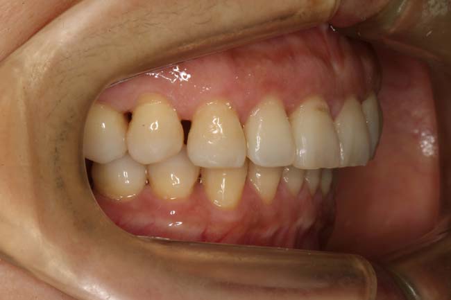 tænder efter behandling med Invisalign