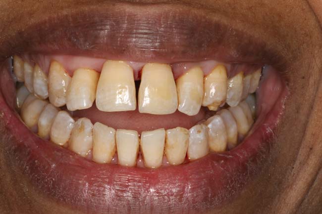 tænder før behandling med Invisalign