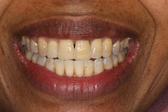 tænder efter behandling med Invisalign