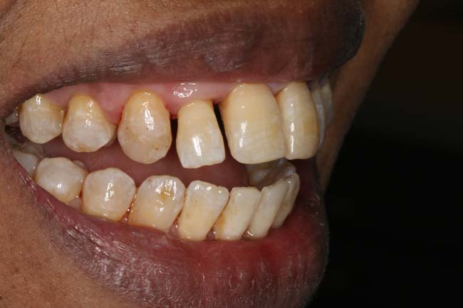 tænder før behandling med Invisalign