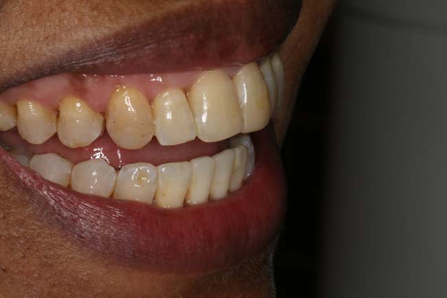 tænder efter behandling med Invisalign