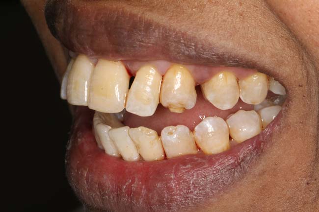 tænder før behandling med Invisalign