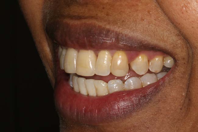 tænder efter behandling med Invisalign