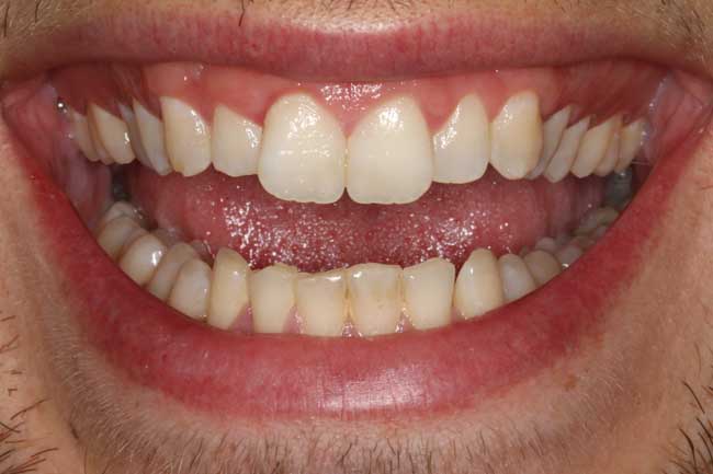 tænder før behandling med Invisalign