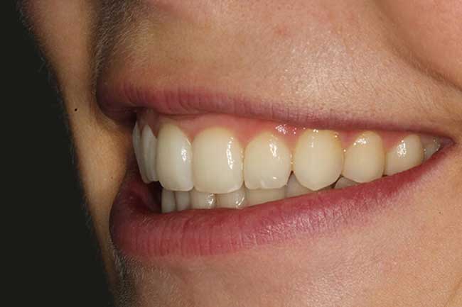 tænder efter behandling med Invisalign