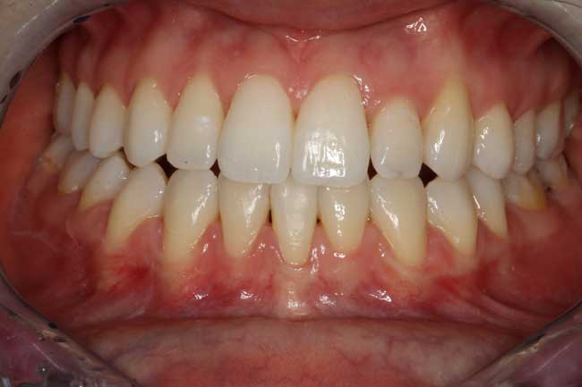 tænder efter behandling med Invisalign